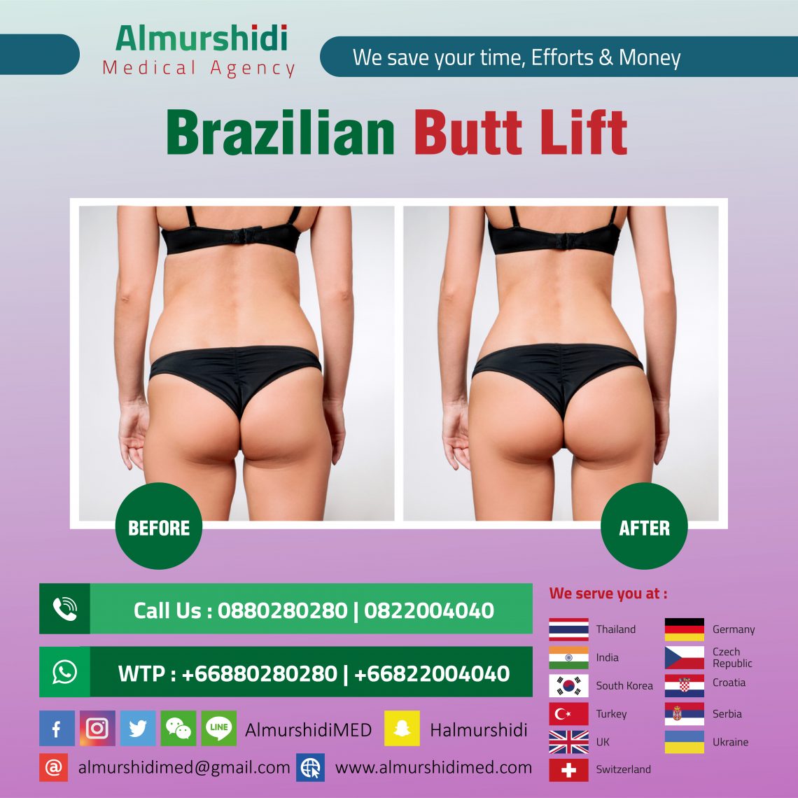 Brazilian butt lifting.