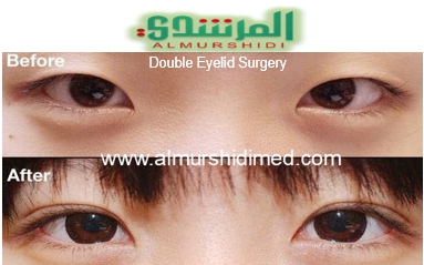 asian eye operation