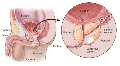 Prostatitis a bőrön