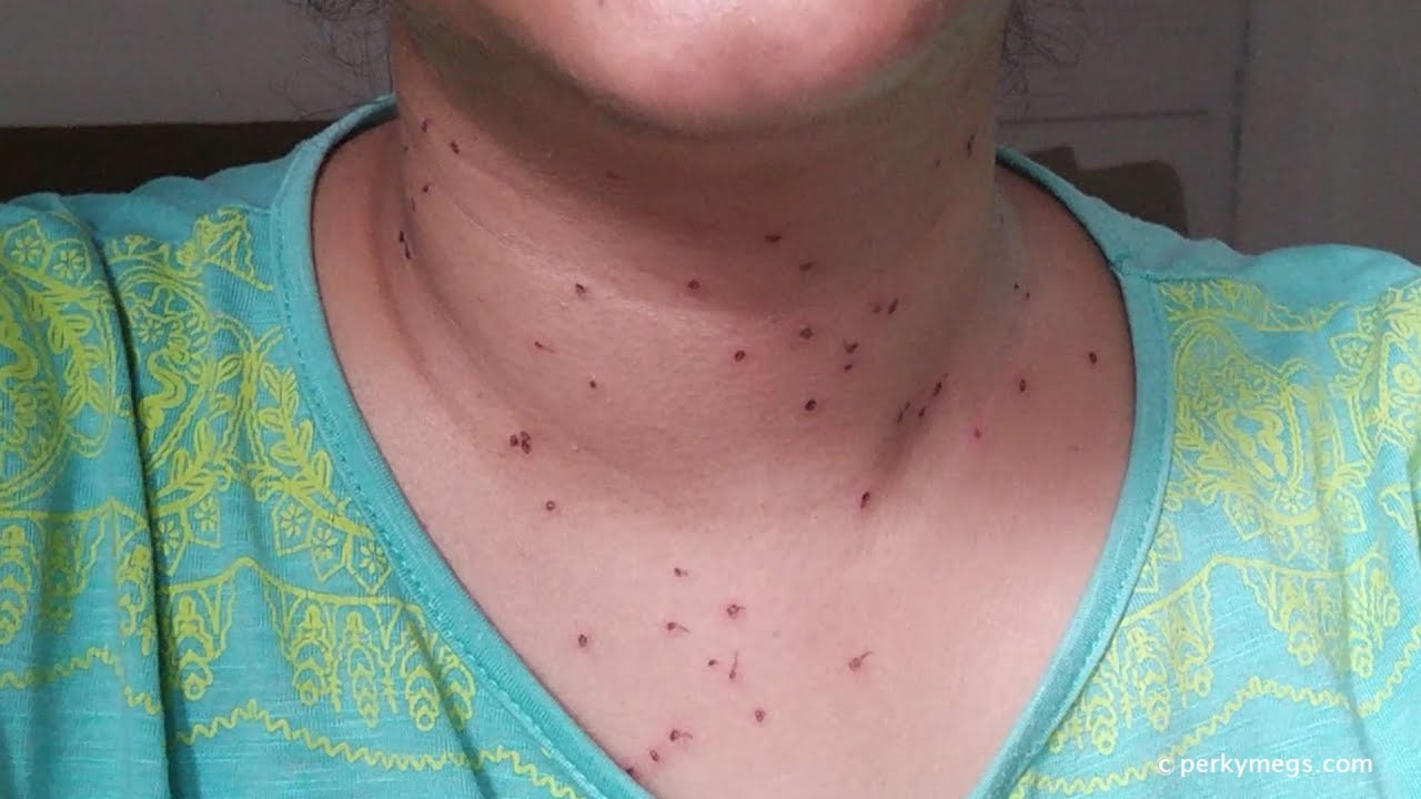 warts treatment on neck