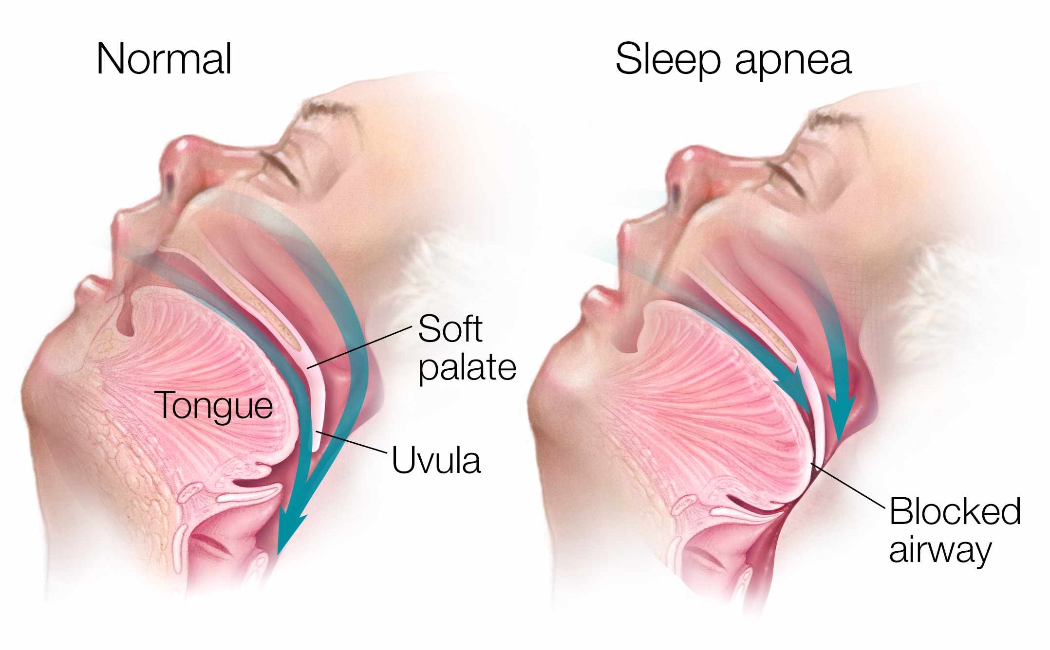 sleep-apnea-diagnosis-and-treatment-in-thailand-almurshidi-medical