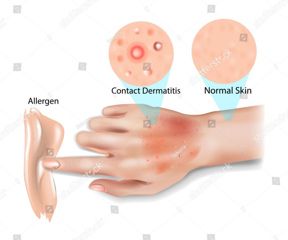 contact dermatitis)