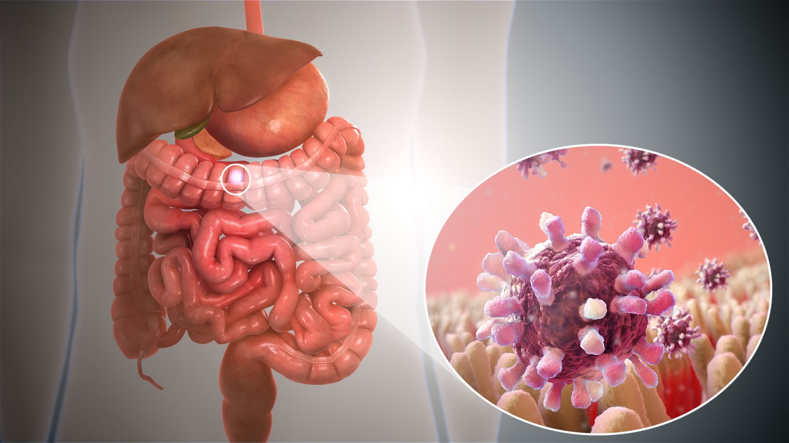 What Is Food Gastroenteritis