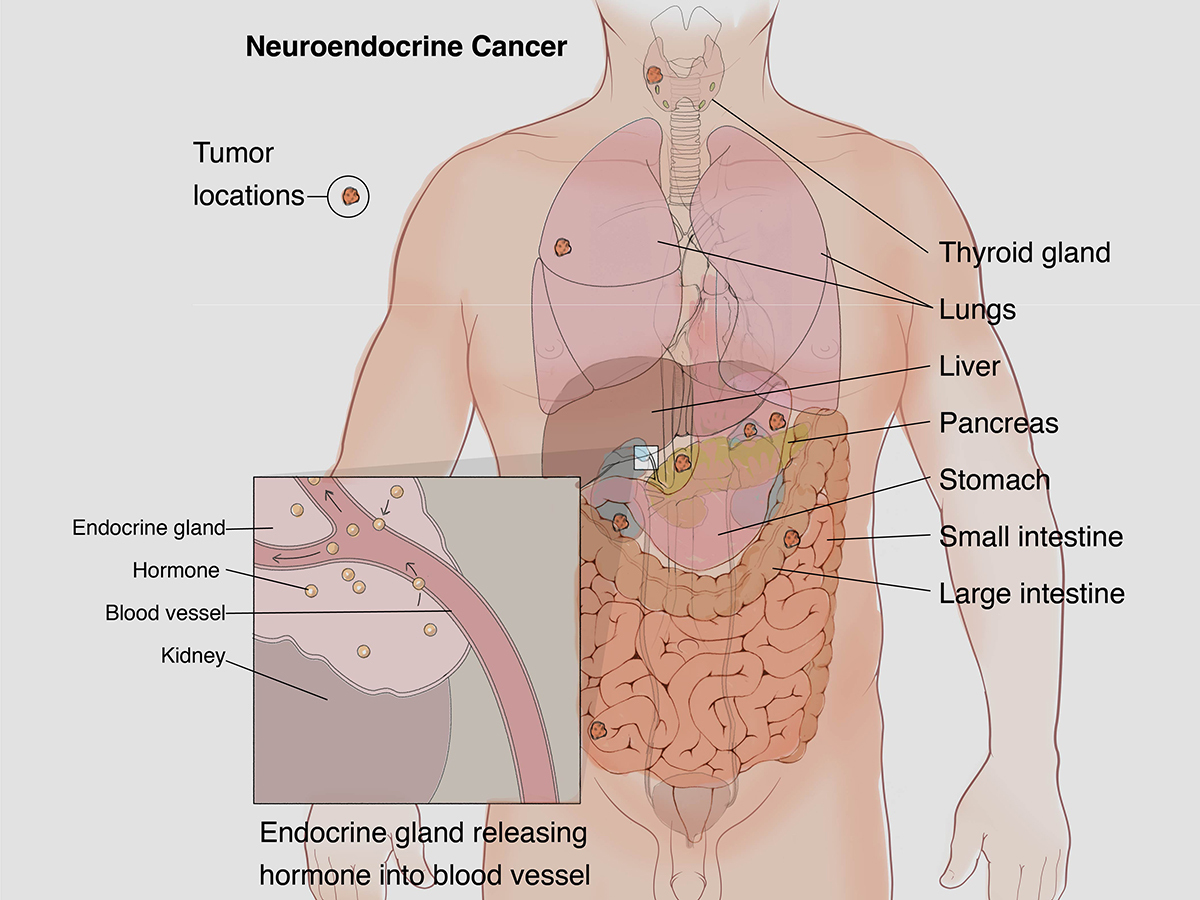 neuroendocrine cancer weight gain