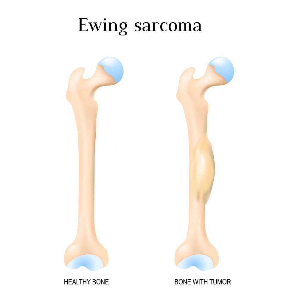 ewing sarcoma cancer