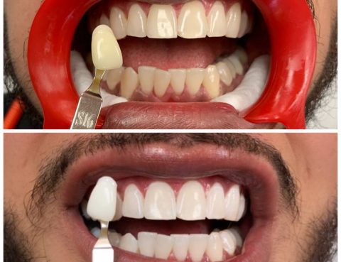 فنير الأسنان