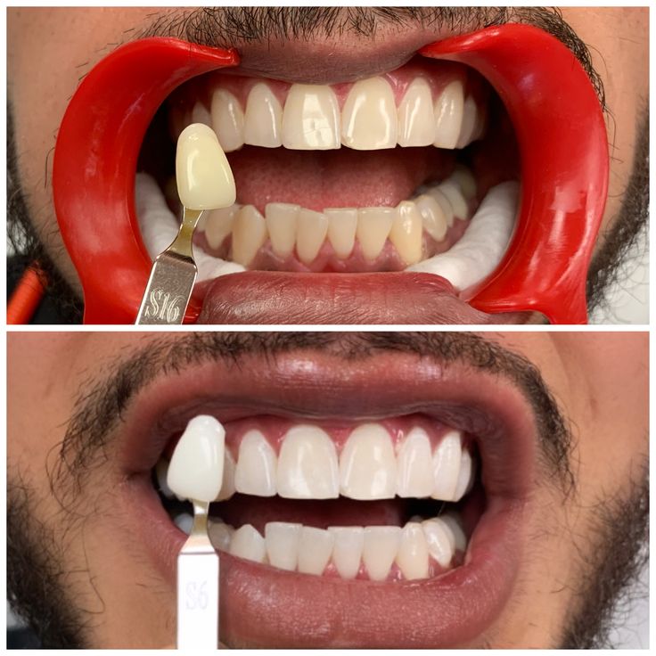 فنير الأسنان