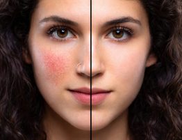 التهاب الجلد