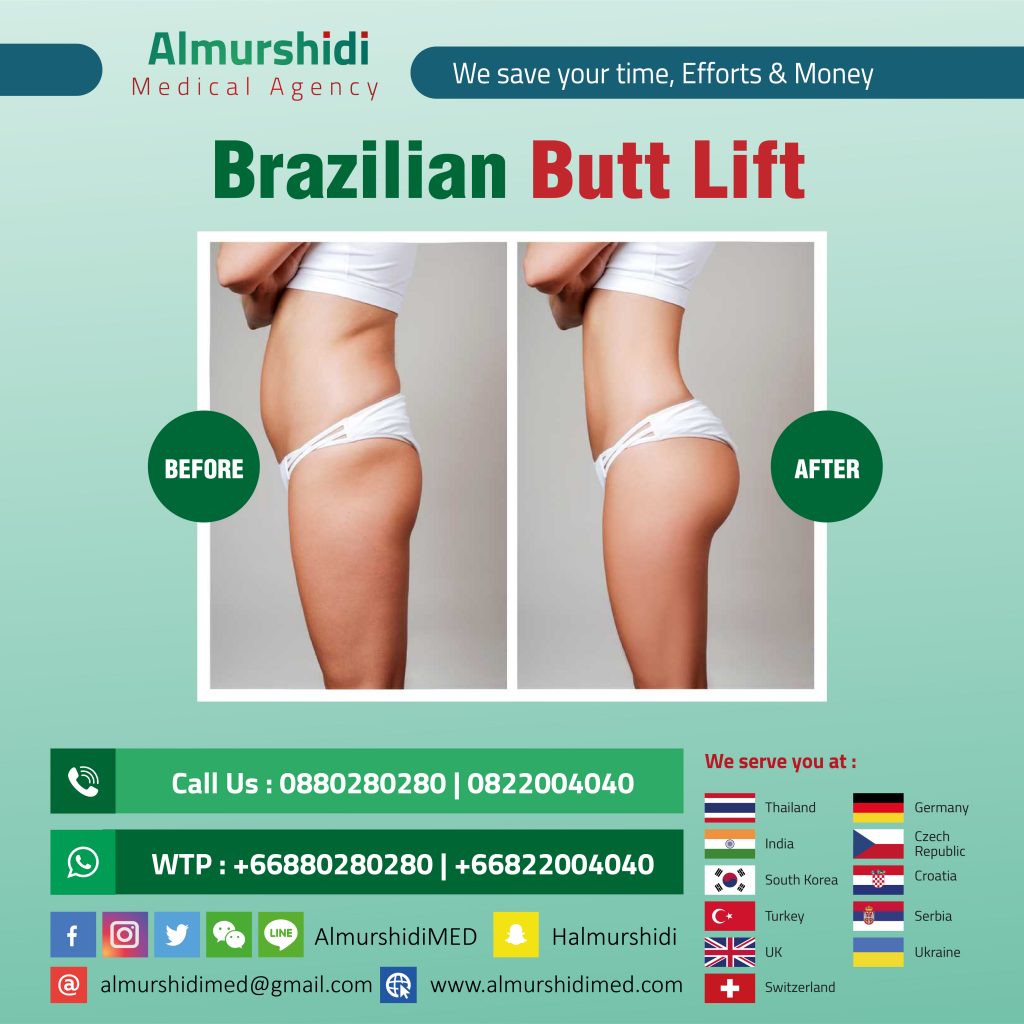 Fat transfer to Butt (Brazilian Butt Lift) in Bangkok, Thailand