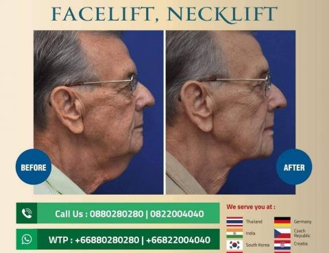 facelift, necklift