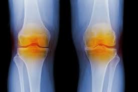 knee replacement surgery in Thailand