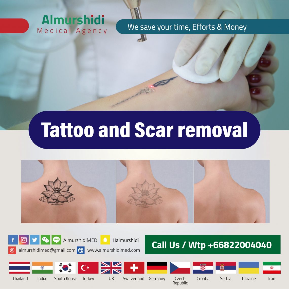 Best Tattoo And Scar Removal in Thailand