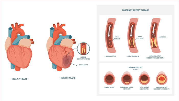 Coronary Heart Disease Diagnosis and Treatment
