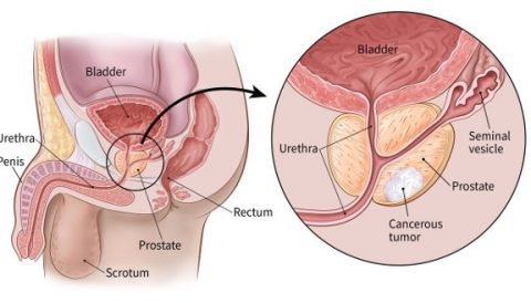 Prostate Cancer Diagnosis and Treatment in Thailand