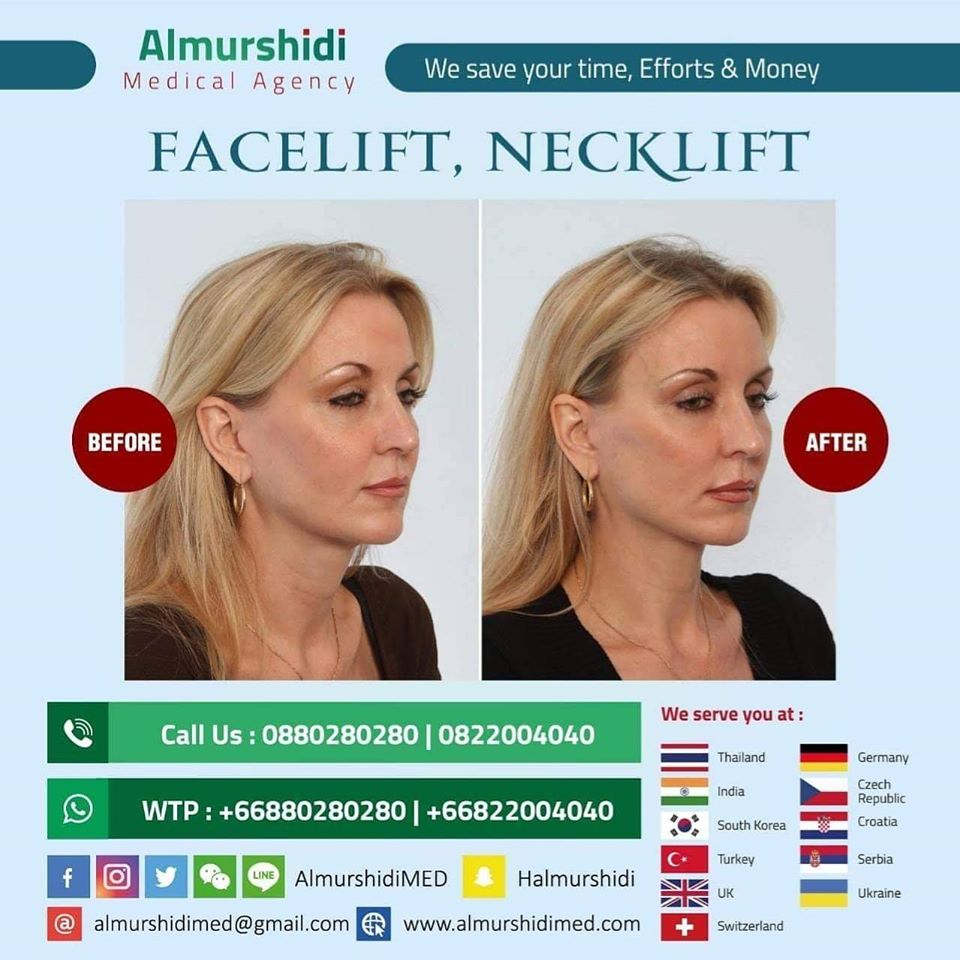 Best Facelift and Necklift Cost in Thailand