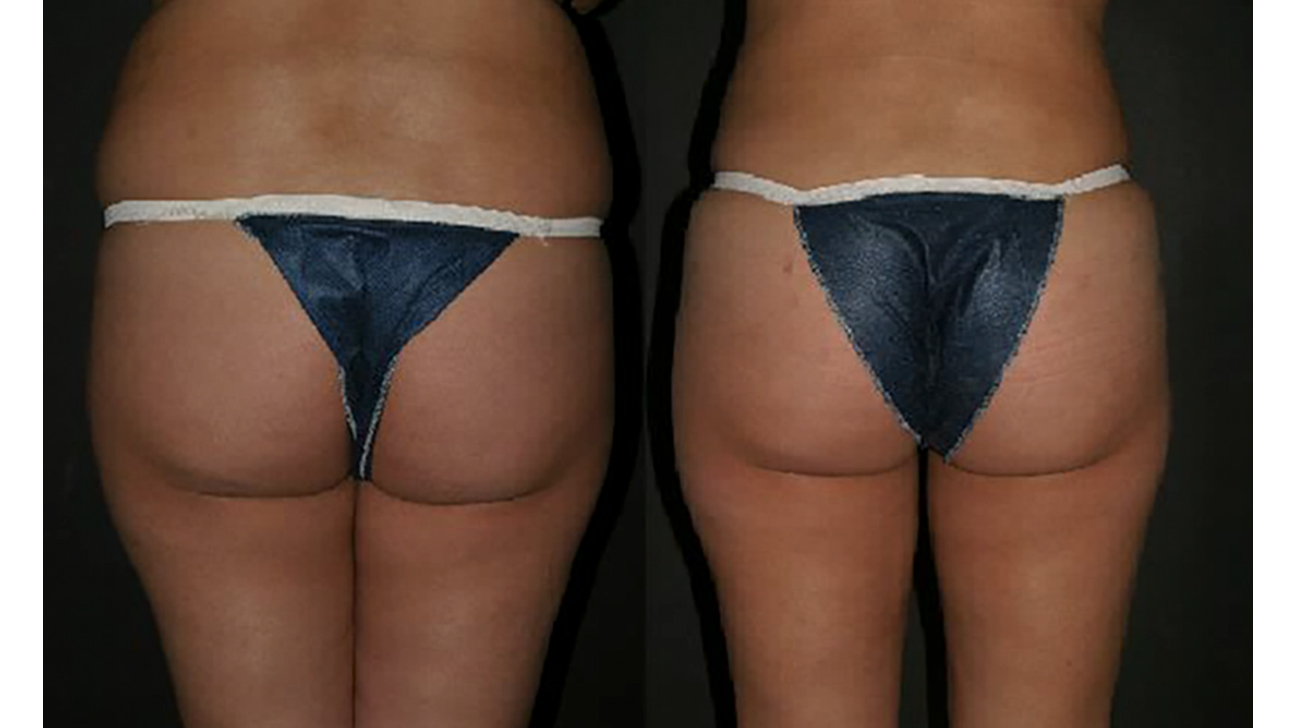 Reduction Brazilian Butt Lift - iMed Medical