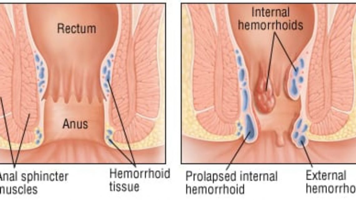 Hemorrhoids Treatment in Thailand