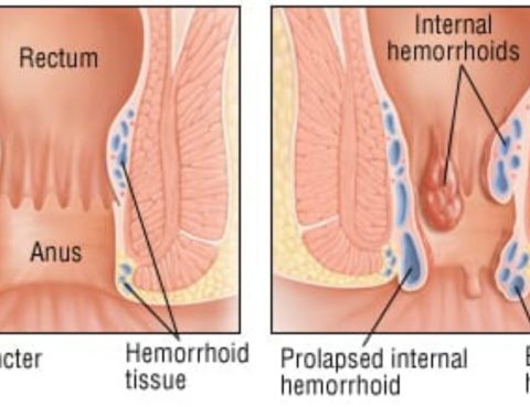 Hemorrhoids Treatment in Thailand