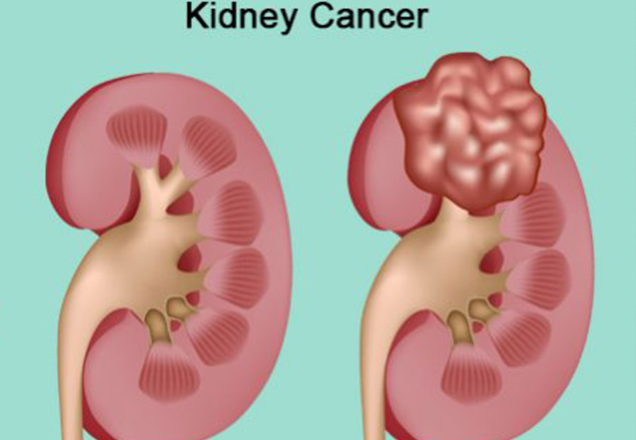 Kidney Cancer Diagnosis and Treatment in Thailand