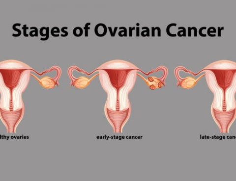 Ovarian Cancer Diagnosis and Treatment in Thailand