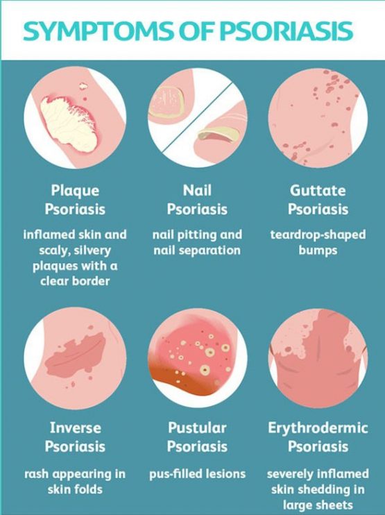 Psoriasis Diagnosis and Treatment in Thailand - Almurshidi Medical ...