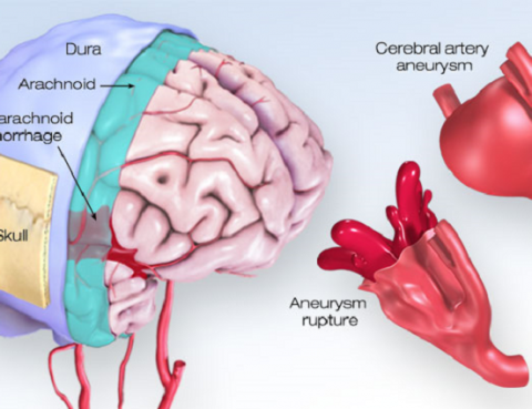 Aneurysm Diagnosis and Treatment in Thailand