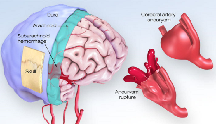 Aneurysm Diagnosis and Treatment in Thailand