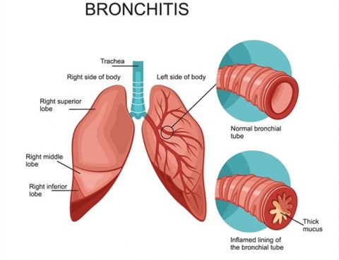 Bronchitis Diagnosis and Treatment