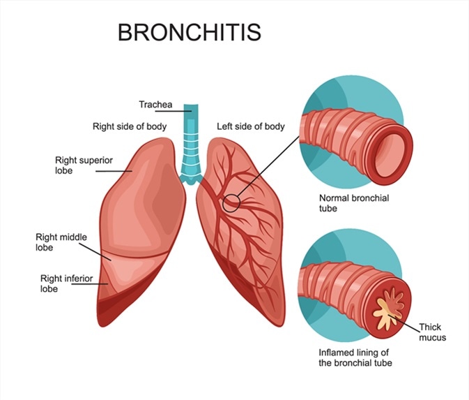Bronchitis Diagnosis and Treatment