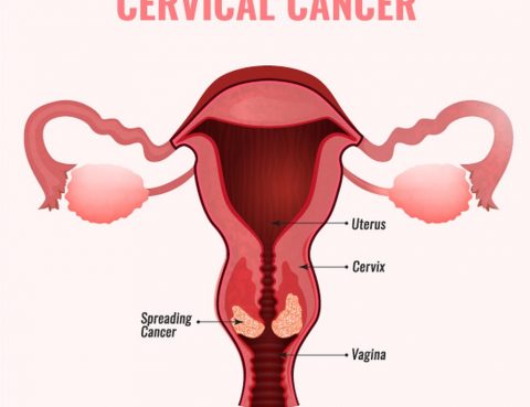 Cervical Cancer Diagnosis and Treatment