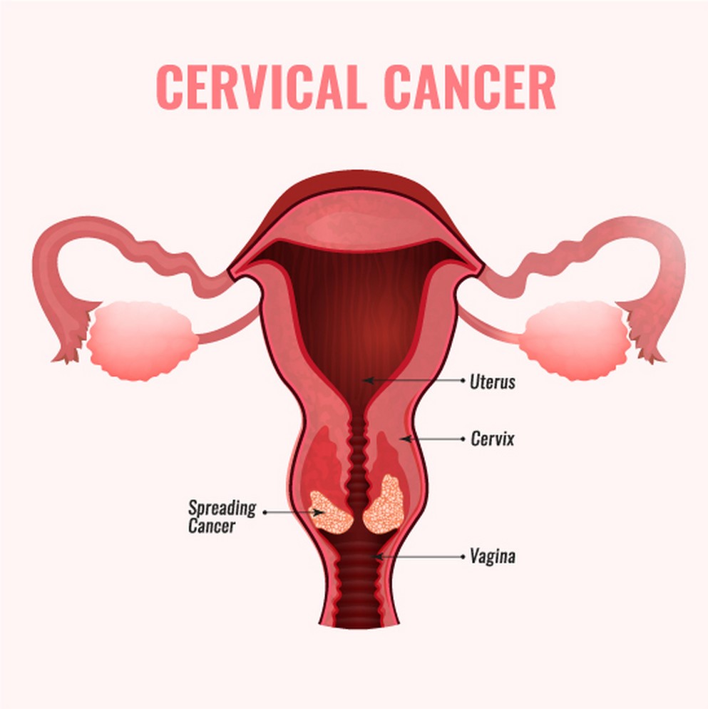 Cervical Cancer Diagnosis and Treatment