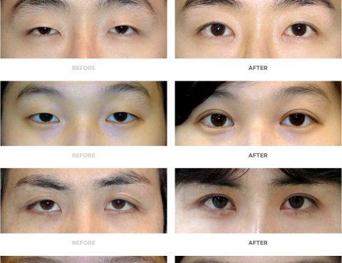 Eyelid Surgery Blepharoplasty in Thailand
