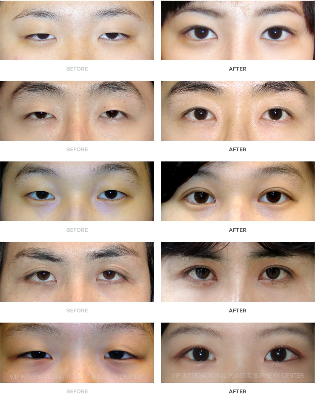 Eyelid Surgery Blepharoplasty in Thailand