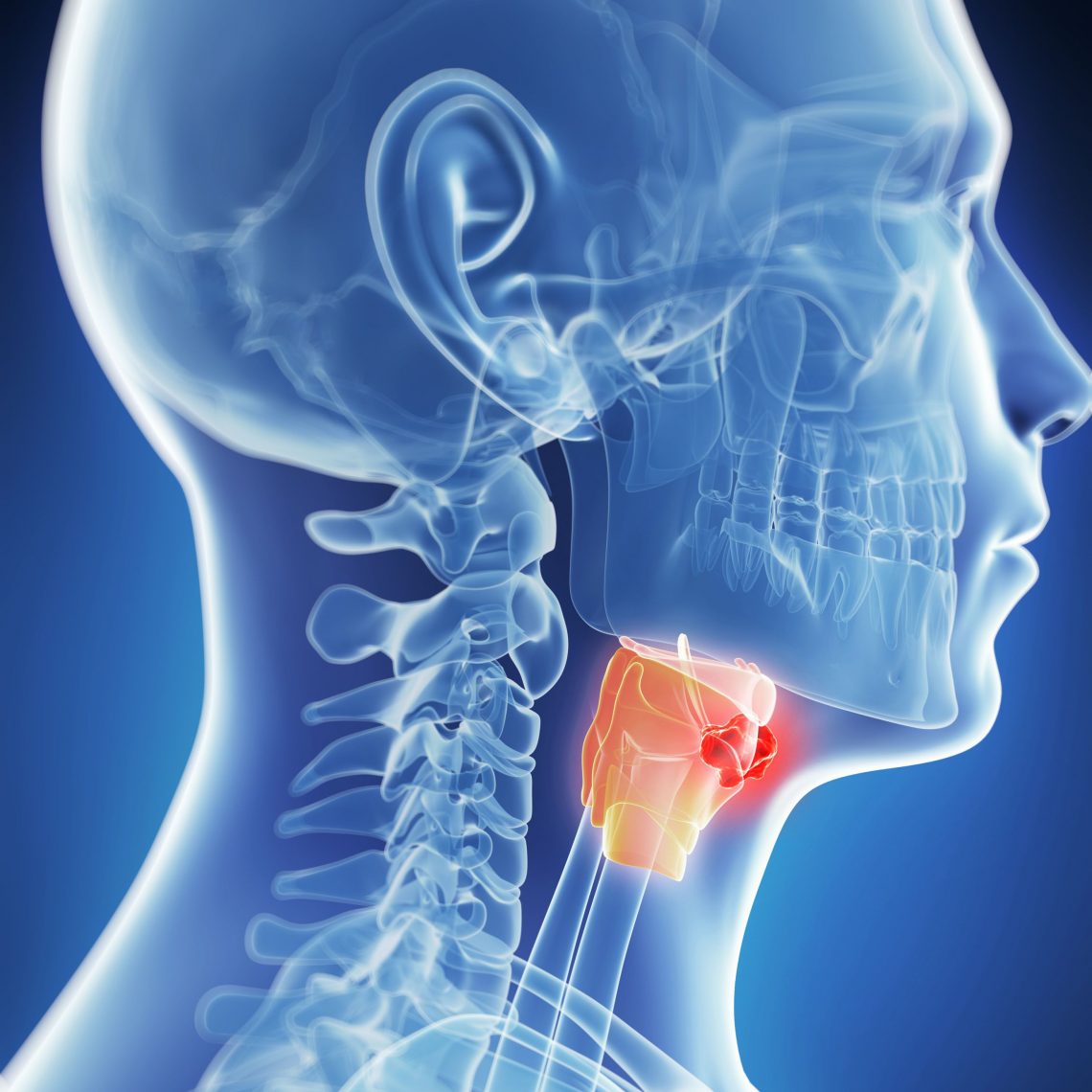 Laryngeal Cancer Diagnosis and Treatment in Thailand