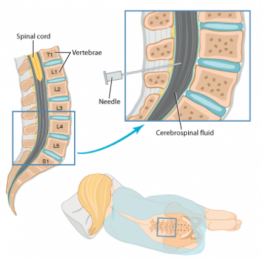 Spinal Tap in Thailand - Almurshidi Medical Tourism - Best Affordable ...