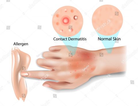 Allergic Contact Dermatitis Diagnosis and Treatment in Thailand
