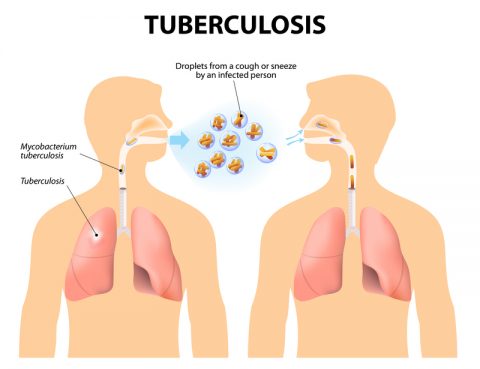 Tuberculosis Diagnosis and Treatment in Thailand
