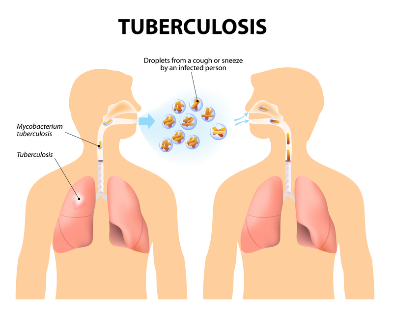 Tuberculosis Diagnosis and Treatment in Thailand