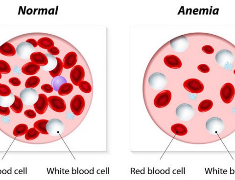 Anemia Diagnosis and Treatment