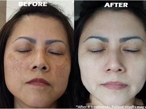 Hyperpigmentation Treatment in Thailand