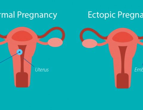 Ectopic Pregnancy Treatment in Thailand