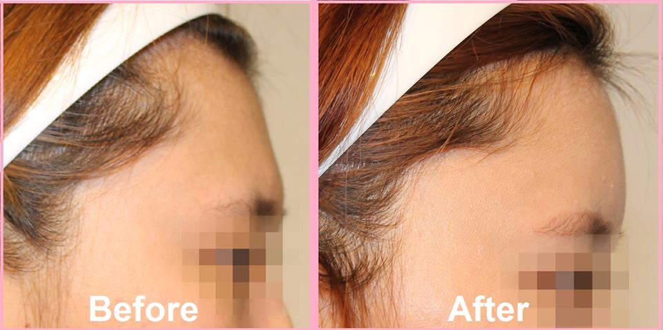 Best Forehead Augmentation in Thailand