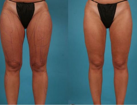 Best Thigh Lift Cost in Thailand