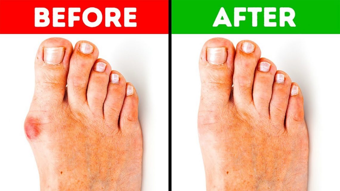 Bunions Treatment in Thailand