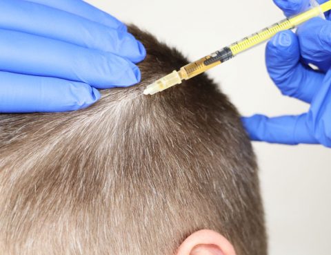 Mesotherapy for Hair in Thailand