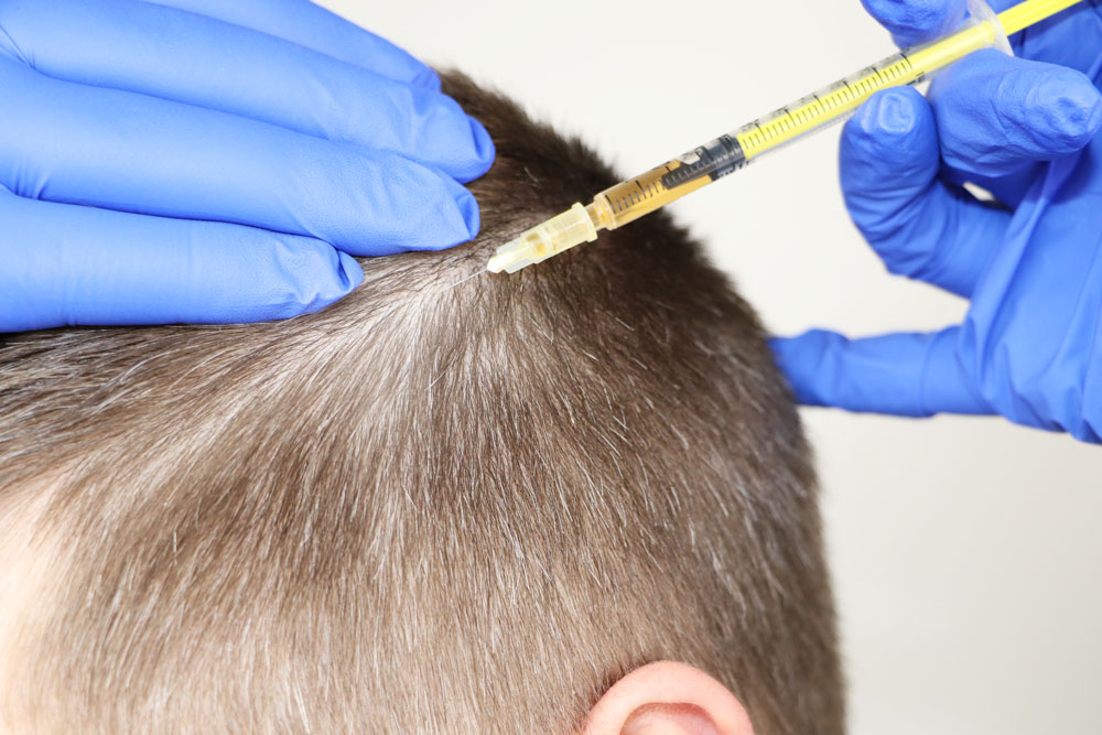 Mesotherapy for Hair in Thailand