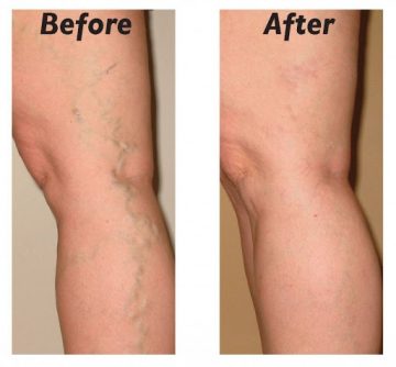 Spider Veins and Varicose Veins Removal in Thailand