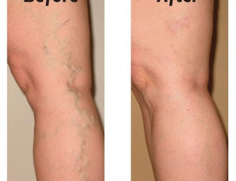 Spider Veins and Varicose Veins Removal in Thailand