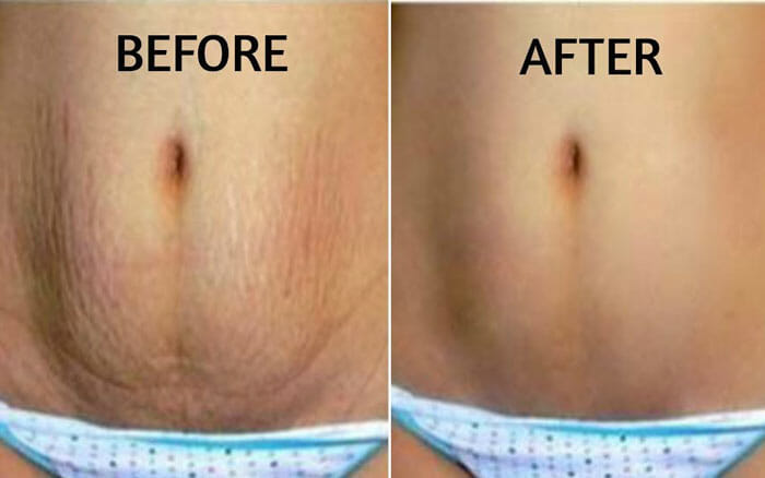 Best Stretch Marks Removal in Thailand