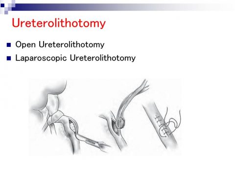 Best Ureterolithotomy Surgery in Thailand